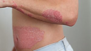 psoriasis meaning in marathi