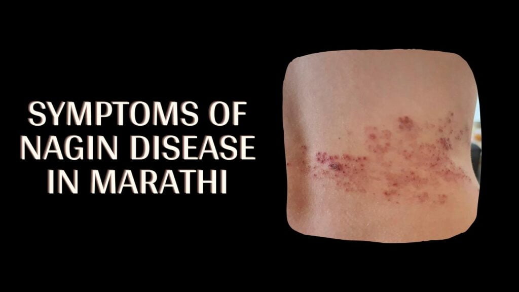 nagin-disease-in-marathi-mayboli-in