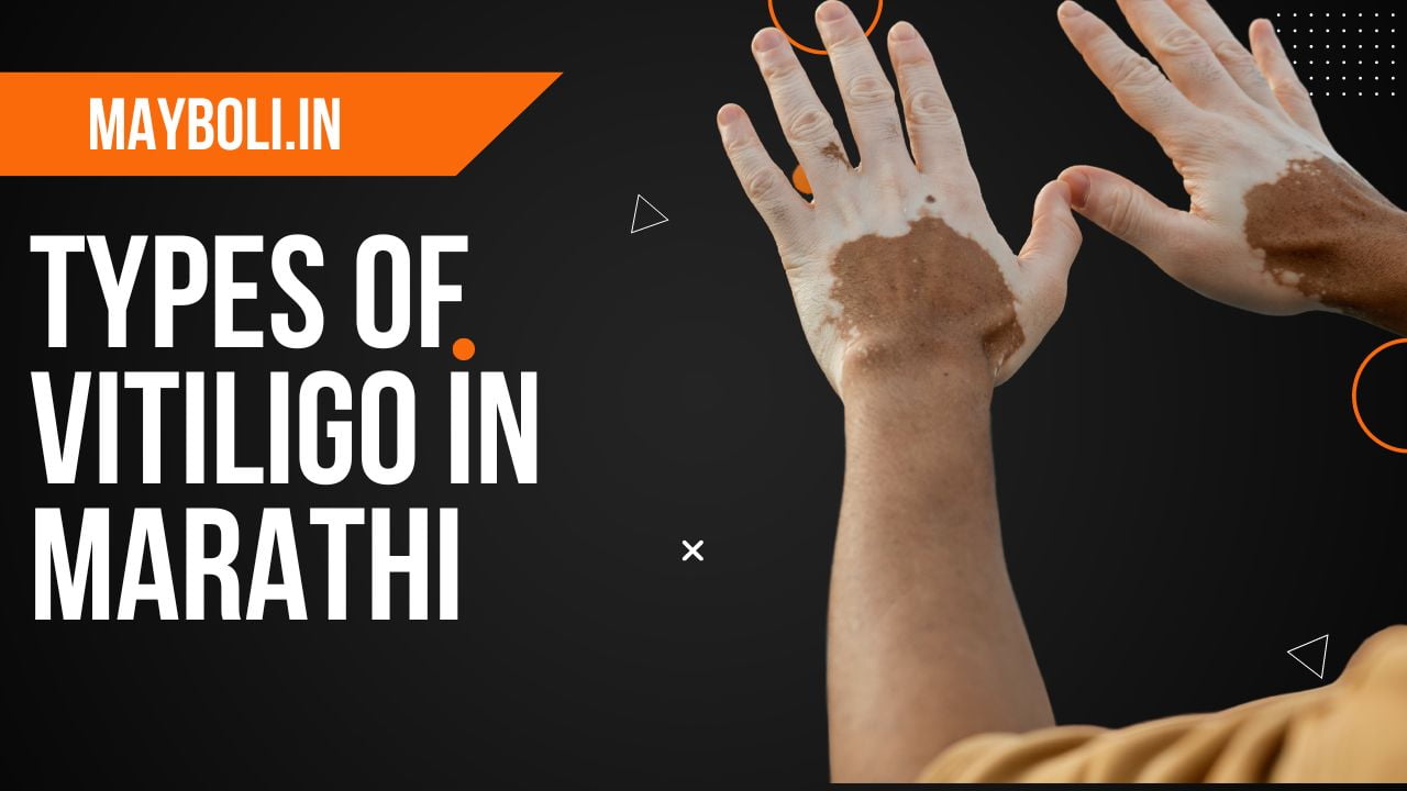 Types of Vitiligo in Marathi