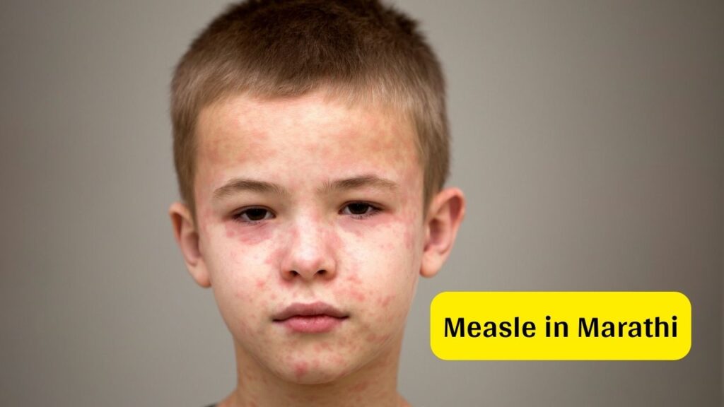 Measles In Marathi Symptoms Causes Treatment Mayboli in measles-in-marathi-symptoms-causes-treatment-mayboli-in