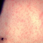 Symptoms of Measles in Marathi