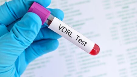 VDRL Test in Marathi