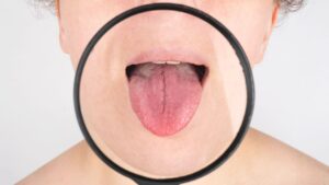 Mouth Cancer Symptoms in Marathi