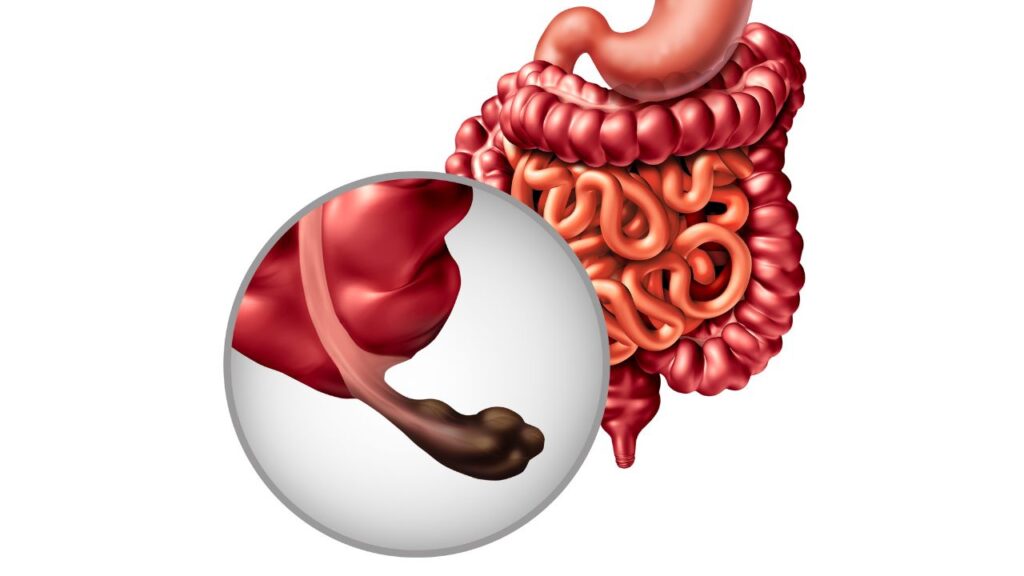 Appendix Symptoms in Marathi