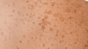 Skin Cancer Symptoms in Marathi
